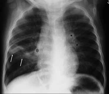 Υπάρχει διαφορά στην ακτινοδιαυγαστικότητα των πνευμόνων με φυσιολογικό εύρος αγγείων αριστερά και μικρή δεξιά πύλη.