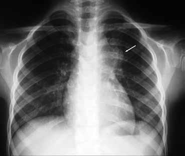 Στην ακτινογραφία σε εκπνοή ο όγκος του αριστερού πνεύμονα έχει σαφώς ελαττωθεί, ενώ ο όγκος του πάσχοντος δεξιού πνεύμονα εμφανίζει αύξηση με σαφώς μικρή