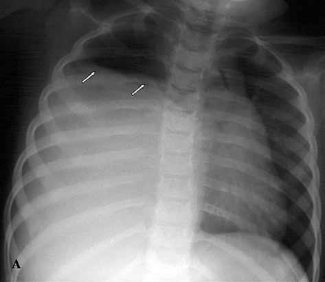 Εικόνα 30. Α. Ακτινογραφία παιδιού με εμπύρετο, δύσπνοια και πνευμονικό βλάστωμα. Υφολική σκίαση δεξιού ημιθωρακίου με απώθηση μεσοθωρακίου προς τα αριστερά.