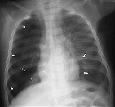 Εικόνα 31. Ακτινογραφία σε κατακεκλιμένη θέση. Μηνοειδούς σχήματος συλλογή αέρα αριστερά (βέλη) δημιουργεί υπερβολικά σαφή καρδιακή παρυφή, σημείο ενδεικτικό πρόσθιου πνευμοθώρακα.
