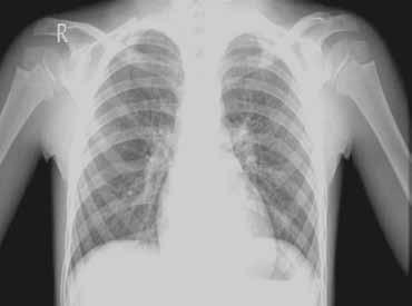 πύλες, καρδιακή παρυφή, πνευμονική αγγείωση, μέγεθος και ακτινοδιαυγαστικότητα πνευμονικών πεδίων, θέση μεσολοβίων, συμμετρία και θέση οστών, μαλακών μορίων, διαφράγματος, πλευροδιαφραγματικές γωνίες.