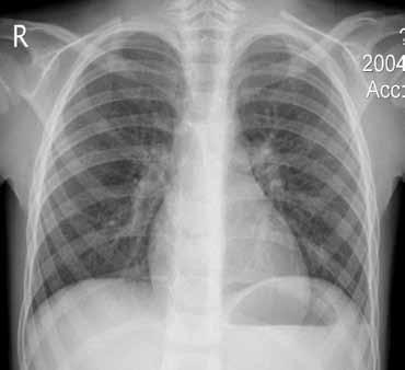 ε) η καρδιακή παρυφή και στ) η ακτινοδιαυγαστικότητα των πνευμονικών πεδίων. Η τραχεία θα πρέπει να απεικονίζεται στη μεσότητα του άνω τριτημορίου του θώρακα.