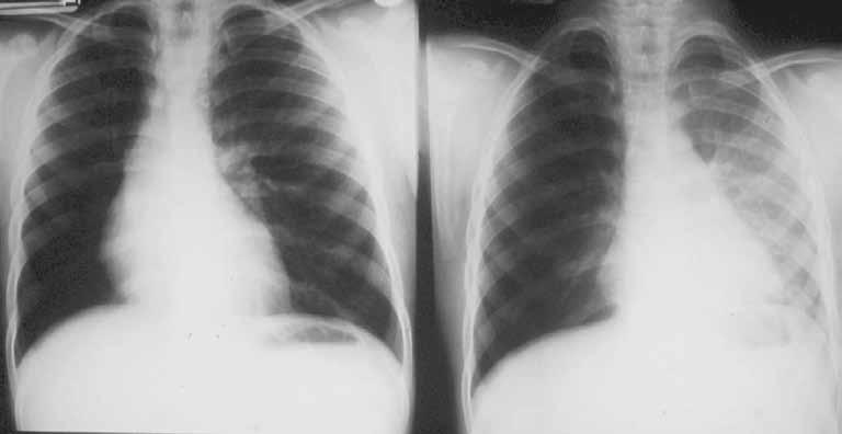 Εικόνα 17. Ετερόπλευρη υπερδιαυγαστικότητα πνευμόνων, σύνδρομο Swyer-James ή McLeod. Ακτινογραφίες σε φάση εισπνοής και εκπνοής, αντίστοιχα. Εικόνα 18.