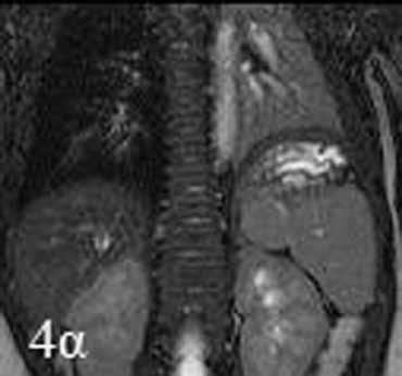 Εικόνα 4. Α. Ταχεία ακολουθία MRI (7 sec) απεικονίζει ατελεκτασία του αριστερού κάτω λοβού. Β.