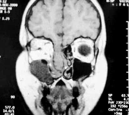 Εικόνα 2. Στεφανιαία Τ1 τομή ΜRI. Εικόνα ρινοηθμοειδικής εγκεφαλοκήλης δεξιά. πόρου, έκτοπο θυρεοειδικό ιστό, δερμοειδείς κύστεις, τερατώματα και ρινοϊνώματα (Εικόνα 3).