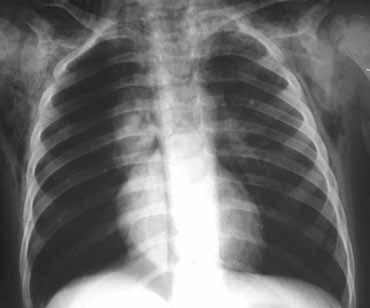 Εικόνα 21. Ακτινογραφία κατά μέτωπο. Εικόνα πνευμοθώρακα δεξιά και υποδορίου εμφυσήματος. Επιπλοκή από ξένο σώμα στο δεξιό βρόγχο.