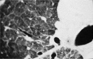 Εικόνα 4. Εικόνα θολής υάλου σε HRCT πνεύμονα λόγω διάχυτης πνευμονικής αιμορραγίας.