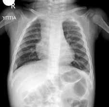 8 Η ακτινογραφική εικόνα της πνευμονικής νόσου διακρίνεται σε διάμεσο και παρεγχυματικό/κυψελιδικό πρότυπο. Το πρώτο συνήθως χαρακτηρίζει τις ιογενείς λοιμώξεις, ενώ το δεύτερο τις βακτηριακές.