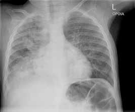 9-11 Τα κύρια ακτινολογικά ευρήματα της ιογενούς λοίμωξης των πνευμόνων στα βρέφη είναι γενικευμένος υπεραερισμός ή ανομοιογενής αερισμός, περιβρογχικές διηθήσεις και μικρές ατελεκτασίες που