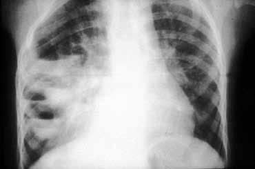 Εικόνα 8. Σταφυλοκοκκική πνευμονία με ανάπτυξη πολλαπλών αποστημάτων και πνευματοκηλών με υγραερικά επίπεδα. λοβούς.