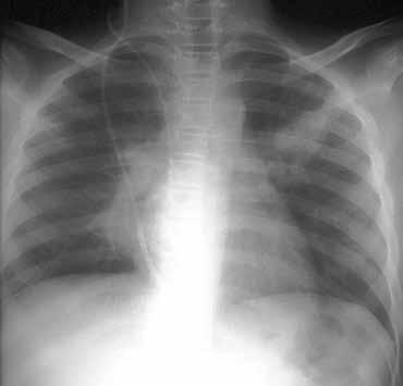 16 Η νέκρωση οφείλεται σε διήθηση των πνευμονικών αγγείων από τις υφές ασπέργιλλου που συχνά οδηγεί σε σχηματισμό κοιλότητας (Εικόνα 11Γ).