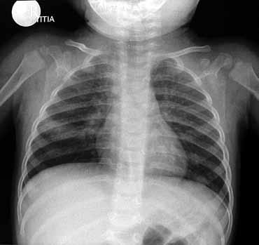 Εικόνα 12. Πρωτοπαθής φυματίωση σε νήπιο με οικογενειακό ιστορικό «ανοικτής» φυματιώδους βλάβης στο περιβάλλον. Εικόνα πρωτοπαθούς συμπλέγματος του Ranke.