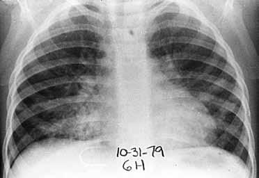 Τυπική ακτινογραφική εικόνα του οξέος κυψελιδικού πνευμονικού οιδήματος είναι η αμφοτερόπλευρη παραπυλαία πύκνωση, σαν πεταλούδα, η θέση και/ή το μέγεθος της οποίας μπορεί να μεταβάλλεται σε διάστημα