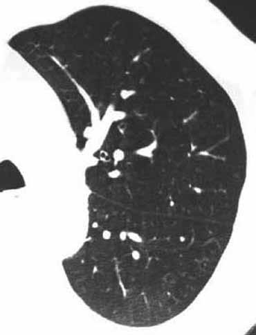 Υπερτερεί της απλής CT διότι εξασφαλίζει λεπτομερέστερες εικόνες του πνευμονικού παρεγχύματος σε μικρότερο χρόνο από αυτόν μιας απλής CT με λεπτές τομές (Εικόνα 6).