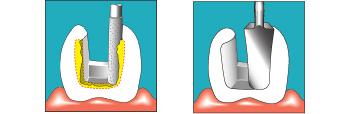 5 Χειρισμός 5.1 Ρύθμιση ισχύος SONICflex 5 Χειρισμός 5.1 Ρύθμιση ισχύος SONICflex Κίνδυνος από τη μη τήρηση της σύστασης ρύθμισης. Η μη τήρηση της σύστασης ρύθμισης οδηγεί στη θραύση του άκρου.