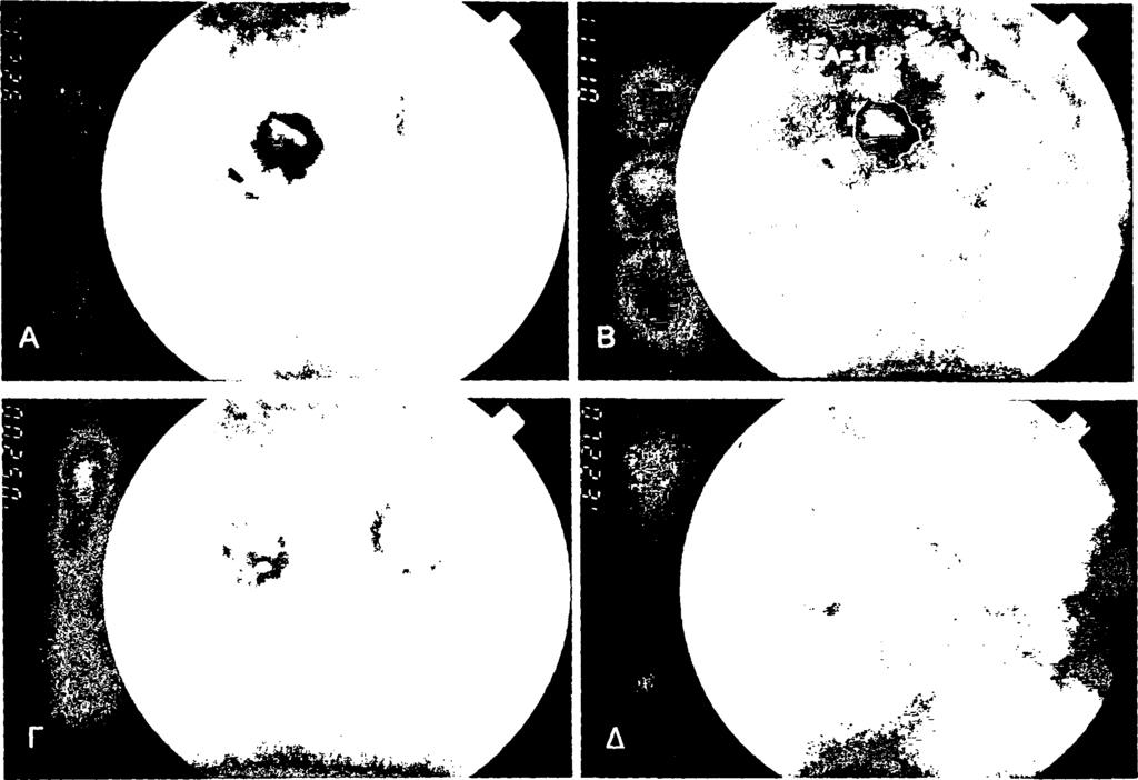 103 Χαρακτηριστικά παραδείγματα όπου το μικρό αρχικό ΣΕΑ (έως 3x106μ2) σχετίζεται με επιτυχή έκβαση όσον αφορά στην τελική έκβαση της οπτικής οξύτητας, φαίνονται στις Εικόνες 23, 24 και 25.
