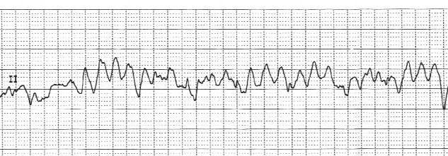 Mean QT interval, ms Η ζνβαξή ππνγιπθαηκία πξνθαιεί παξάηαζε ηνπ QTc 450 P=0.