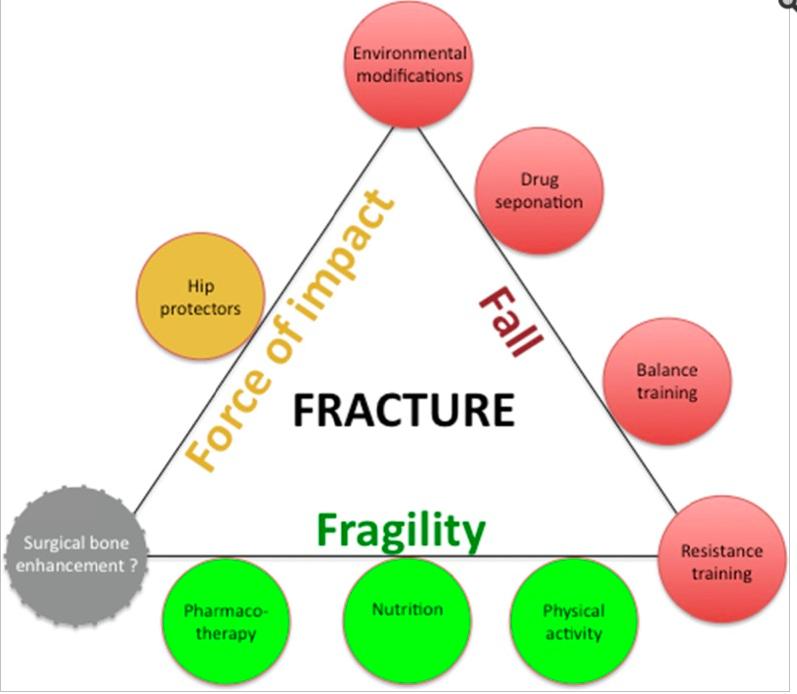 The fracture prevention triangle [62]. Adapted from Cryer C, Patel S. Falls, fragility and fractures. National service framework for older people.