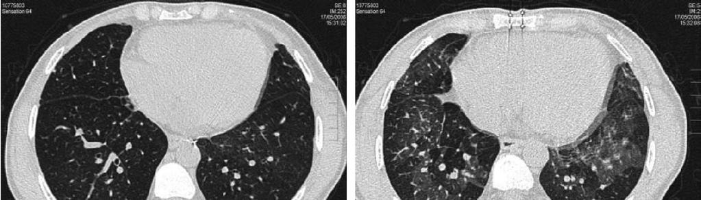 Bronchiolitis Obliterans Syndrome-BOS (GVHD) Inspiration Expiration Inhomogeneous appearance of lung parenchyma Mosaic pattern Sharp demarcation, reduced vessel