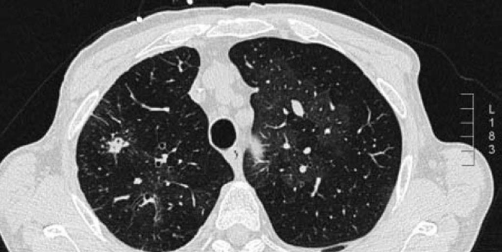 Chronic Thromboembolic Pulmonary Hypertension