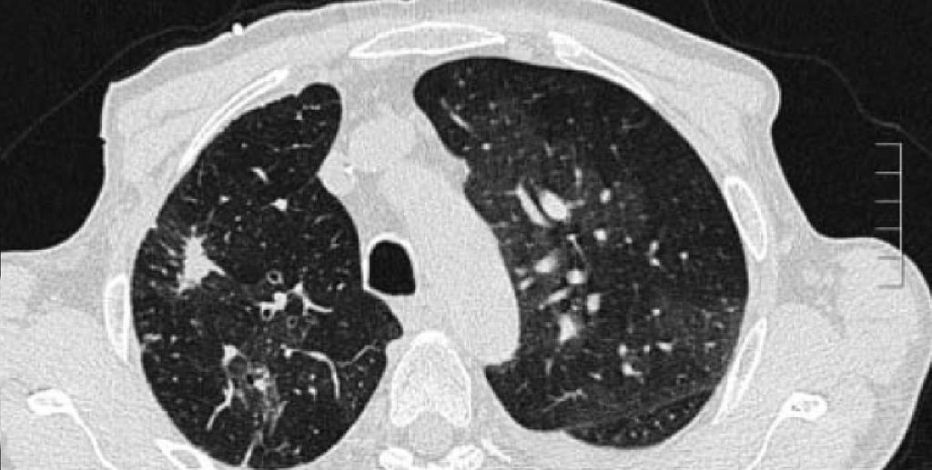 appearance of lung parenchyma Mosaic pattern
