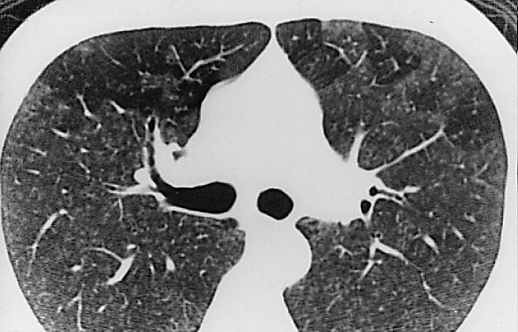 Inspiration Hypersensitivity pneumonitis Expiration Inhomogeneous appearance