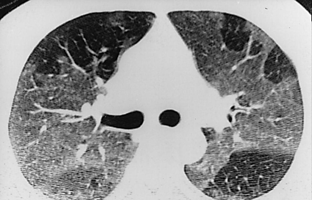 O.S. Centrilobular pattern in high attenuation areas parenchymal disease (1)