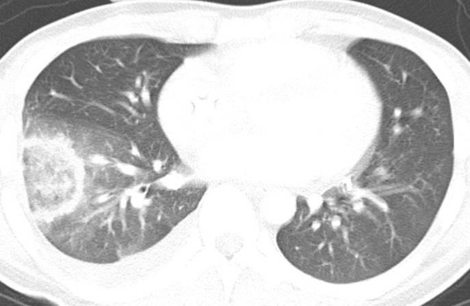 Adenocarcinoma, lepidic growth, 78M GGO internal + peripheral rim of