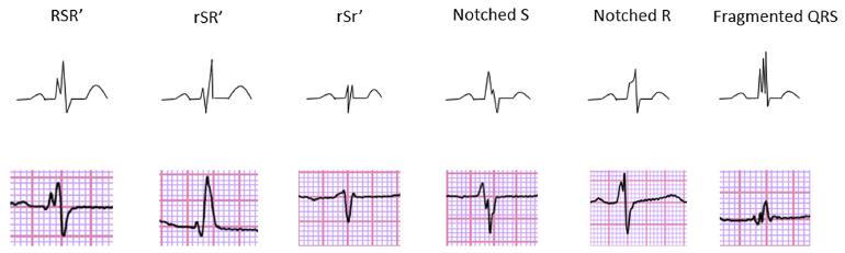 Fragmented narrow QRS 1969 Flowers N: high-frequency components more commonly observed in patients with prior myocardial infarction (Circulation 1969) 2006 Das M: Significance of a fragmented QRS