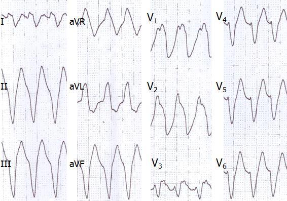 2 η VT (2013) HΦΕ, πρόκληση IVT ablation Επανεισαγωγή 3 η VT, ΗΦΕ