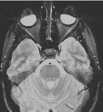 Εικόνα 2.3: Απεικόνιση Μαγνητικού Συντονισμού εγκεφάλου ασθενούς με μάσκαρα στα βλέφαρα των ματιών.