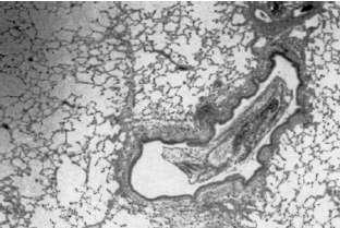 Εικόνα 8 Ο βρογχικός βλεννογόνος ασθενούς με άσθμα, όπως φαίνεται στο οπτικό μικροσκόπιο.