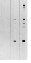 anemie feripriva, hipoglicemie, citoliza hepatica, incarcatura virala HIV nedetectabila in plasma si LCR si o valoare foarte scazuta a imunitatii celulare.