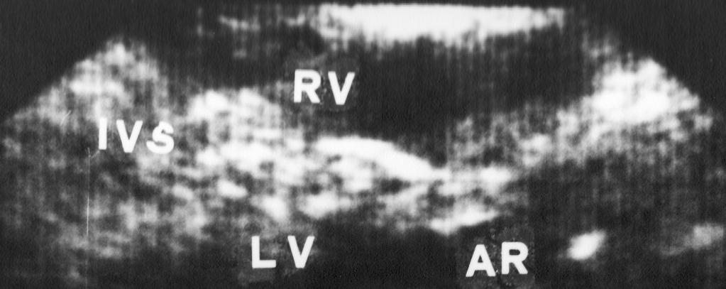 ASYMMETRIC SEPTAL