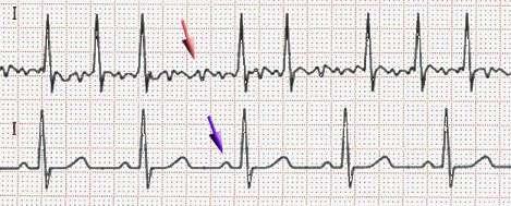 Figura 14. Sus: traseul ECG în fibrilație atrială. Observați undele f neregulate și ritmul ventricular neregulat.