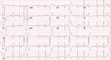 RVOT PVCs ECG characteristics Ventricular arrhythmias from the RVOT region have an LBBB QRS morphology with an inferior axis in