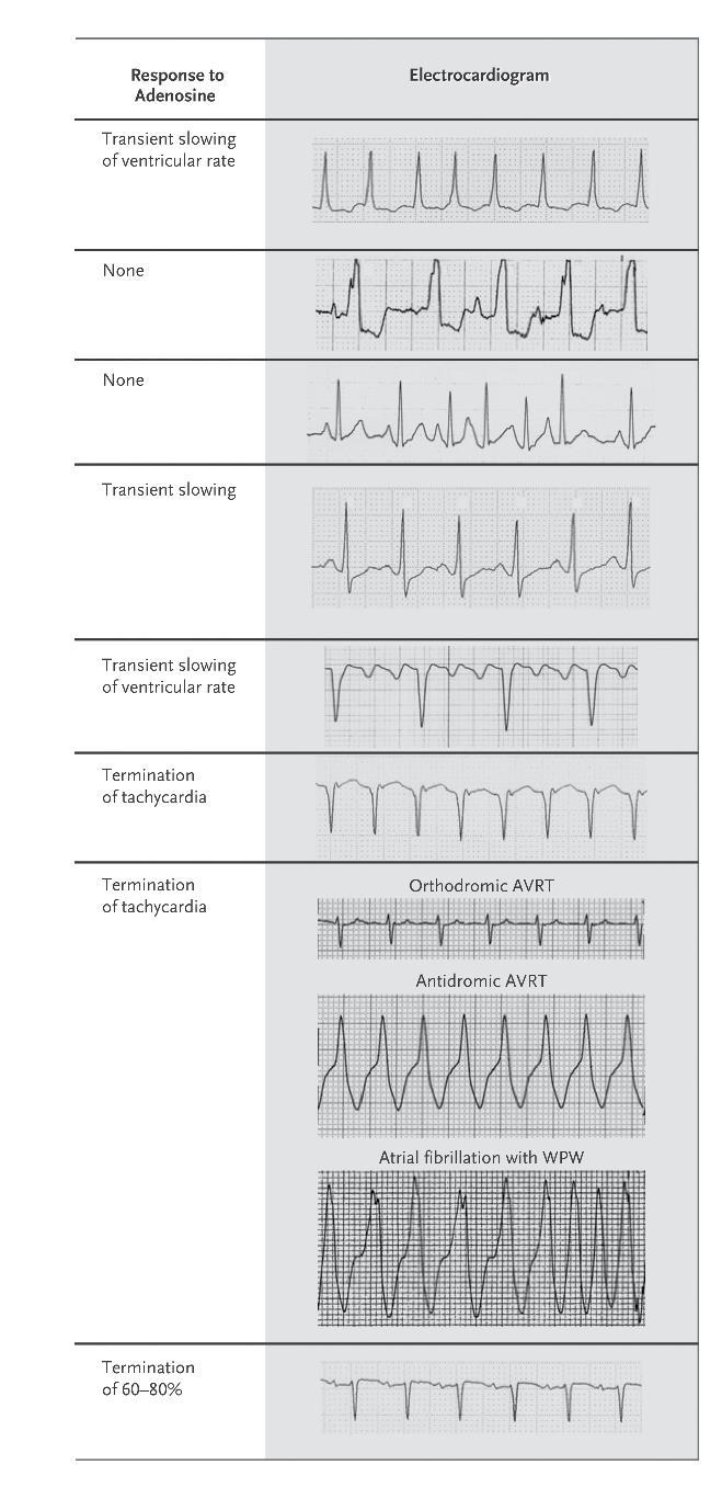 Diferencijalna dijagnoza SVT i adenozin Odgovor na adenozin Tranzitorno usporenje VF Ne Ne Tranzitorno usporenje