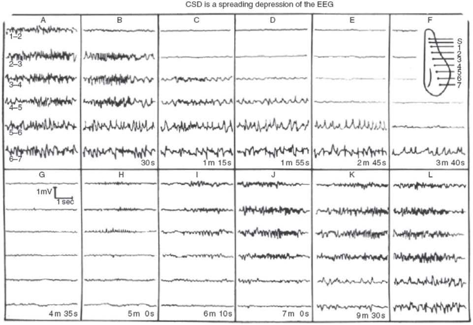 Talas kortikalne depolarizacije CSD Astrides Leao 1914.-1993. neuropsiholog, PhD na Harvardu 1943. EEG tokom el.