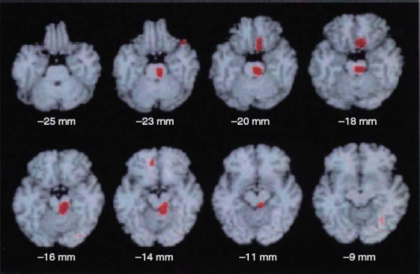 Moždano stablo kao generator migrene PET studije protoka 9 bolesnika, spontani ataci Aktivacija u cingulatnom, vizuelnom i audivnom asoc.