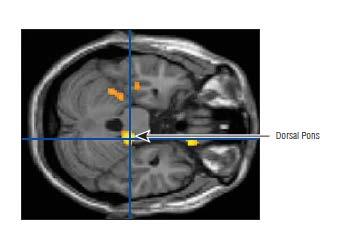Moždano stablo kao generator migrene U isto vreme: Aktivacija u ipsilateralnom ponsu Deaktivacija u kontralateralnom ponsu