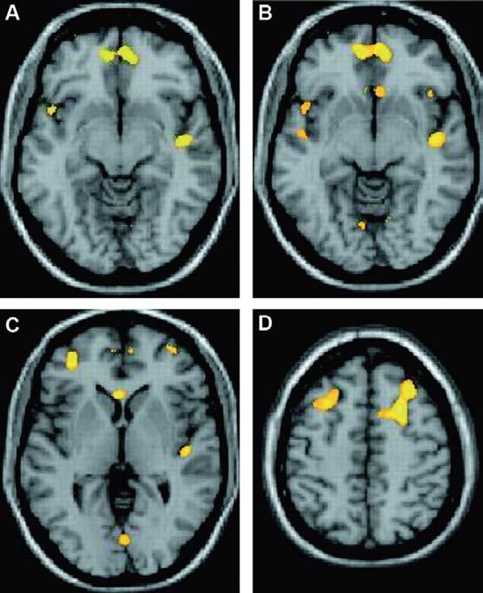 Redukcija gustine neurona (VBM) Bela masa: frontalno, parijetalno i okcipitalno Siva masa: frontalno, temporalno, prednji cingulum,
