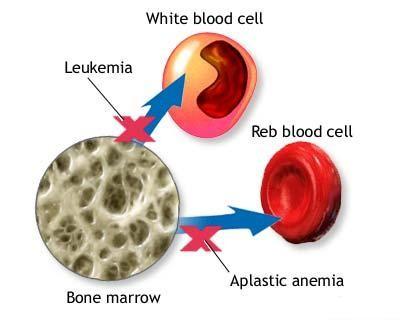 Μεταμόσχευση αιμοποιητικών βλαστικών κυττάρων -καρκίνος -ασθένειες του αιμοποιητικού (απλαστική