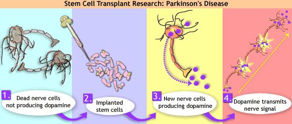 Parkinson s