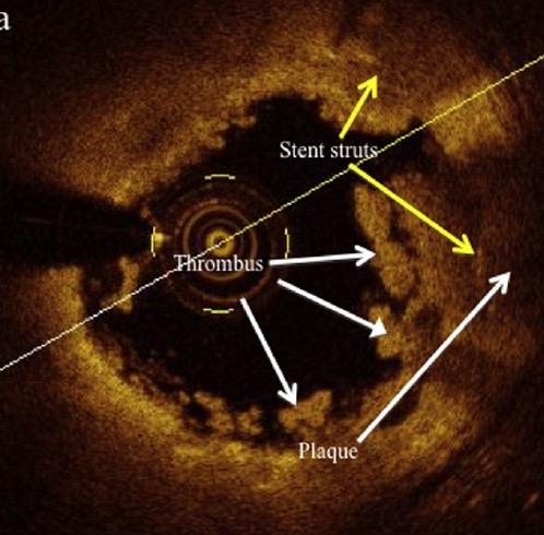 " Growth of neo-intimal atherosclerosis inside a previously implanted coronary stent " Reported in both BMS and DES, BUT at an