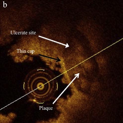 Lack of functional endothelialized luminal surface within stented segment!