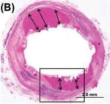 malapposition of stent
