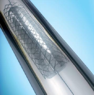 ! Mortality not influenced by lower ST: may be due to a general lack of statistical power due to an overall low number of definite stent thrombosis!