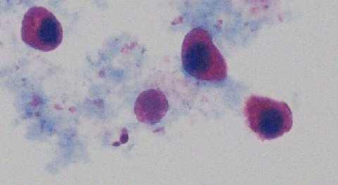 Renálne epitelové bunky Renálne tubulárne epitélie pochádzajú z epitelovej výstelky renálnych tubulov závažný