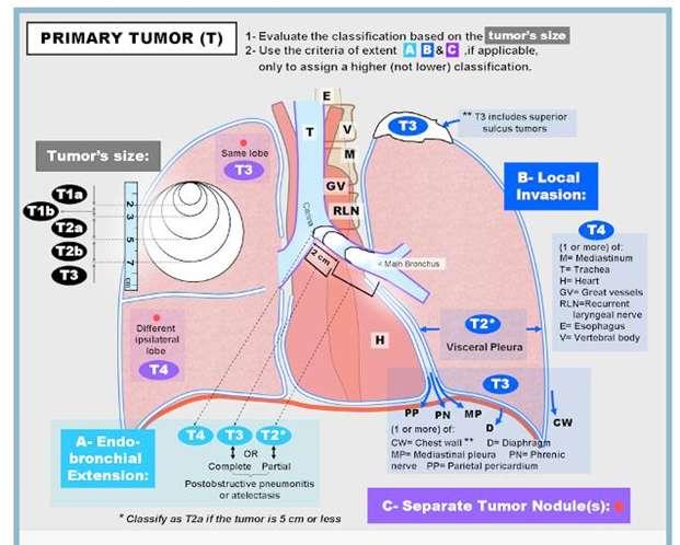 ΠΑΡΑΓΩΝ Τ (TUMOR) ΠΑΡΑΓΩΝ Τ 1. Μέγεθος του όγκου 2.