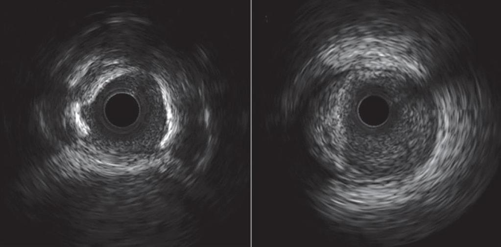 IVUS Showing a Circumferential
